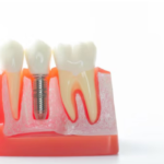 Cost of Basal Implants in Pune: What You Should Know